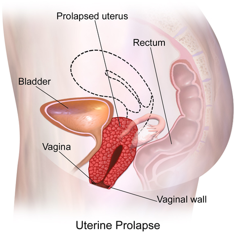 Uterine prolapse, natural treatments